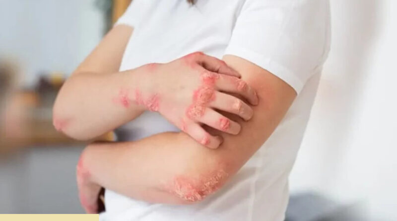 lawan infeksi jamur kulit dengan 5 cara alami yang ampuh dan mudah dilakukan