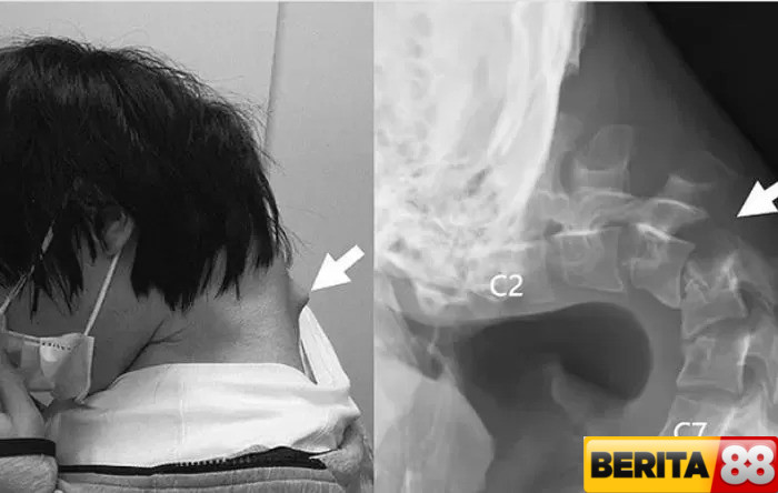 keseringan menggunakan ponsel diklaim menyebabkan kepala tertunduk